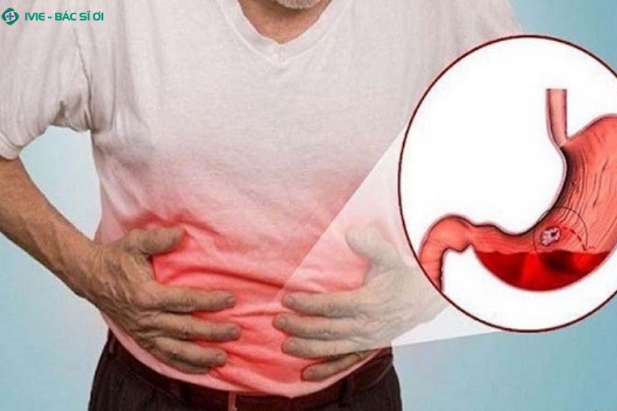 Tìm hiểu xuất huyết dạ dày bao lâu thì khỏi và các yếu tố ảnh hưởng đến thời gian hồi phục