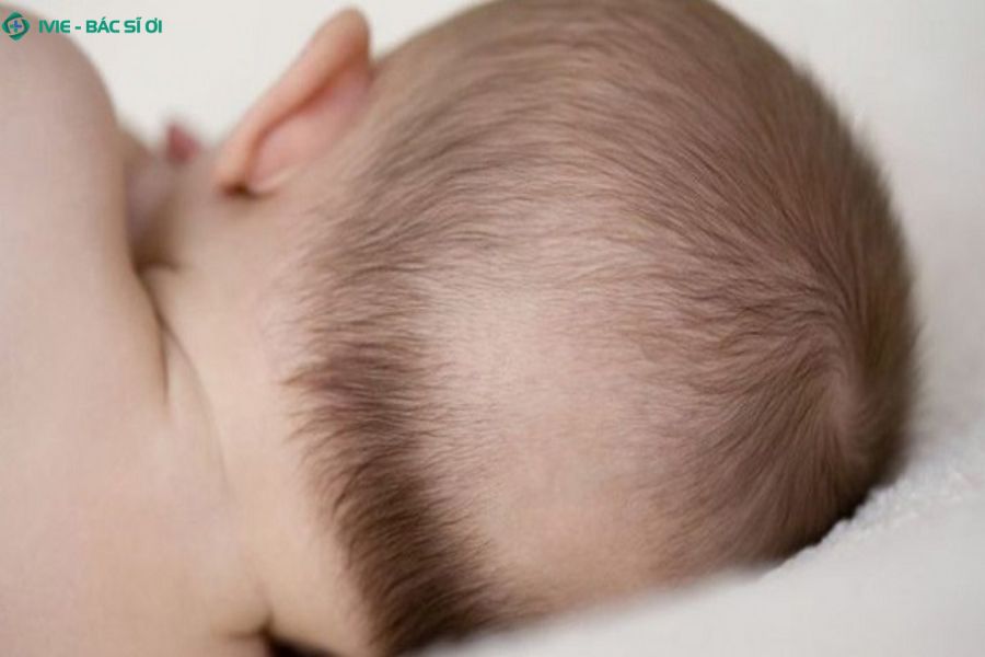 Nguyên nhân rụng tóc vành khăn ở trẻ 3 tháng tuổi