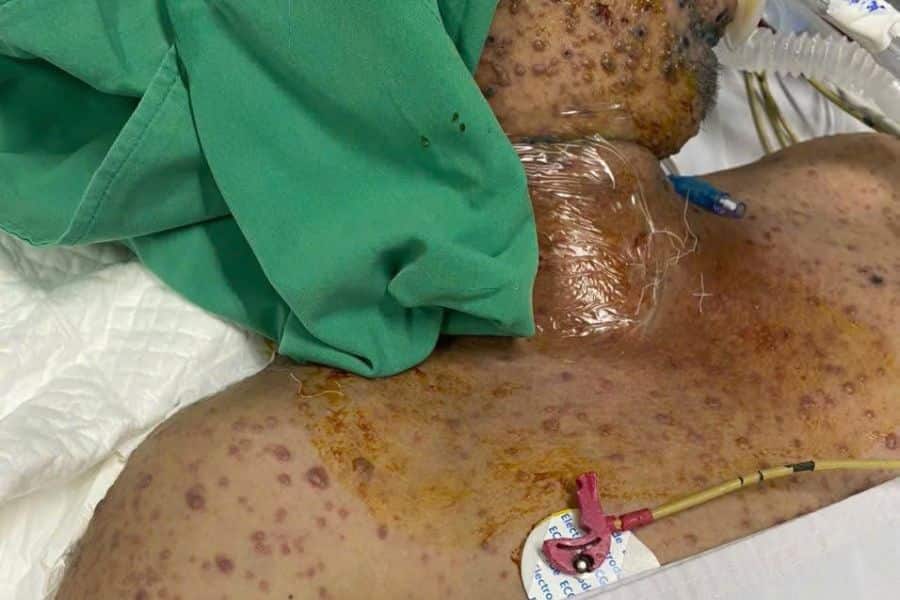 Đội ngũ y bác sĩ chuyên khoa tại Bệnh viện Đa khoa Thành phố Cần Thơ đảm bảo quy trình thăm khám và điều trị bỏng an toàn, vô trùng chuẩn y khoa