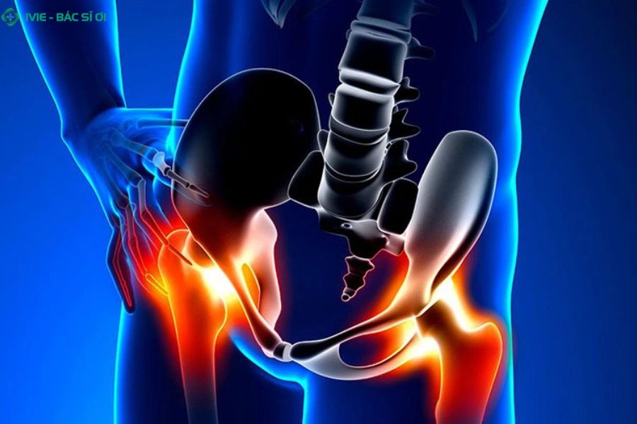 Căng cơ háng là tình trạng các sợi cơ ở vùng mặt trong đùi bị kéo giãn hoặc rách