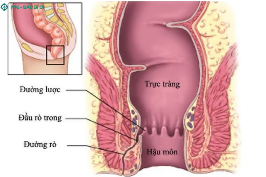 Cơ chế lây nhiễm HIV qua đường hậu môn ở nhóm MSM và tầm quan trọng của việc sử dụng biện pháp bảo vệ