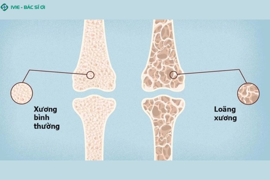 Khi mật độ xương giảm khiến xương giòn, dễ gãy hơn