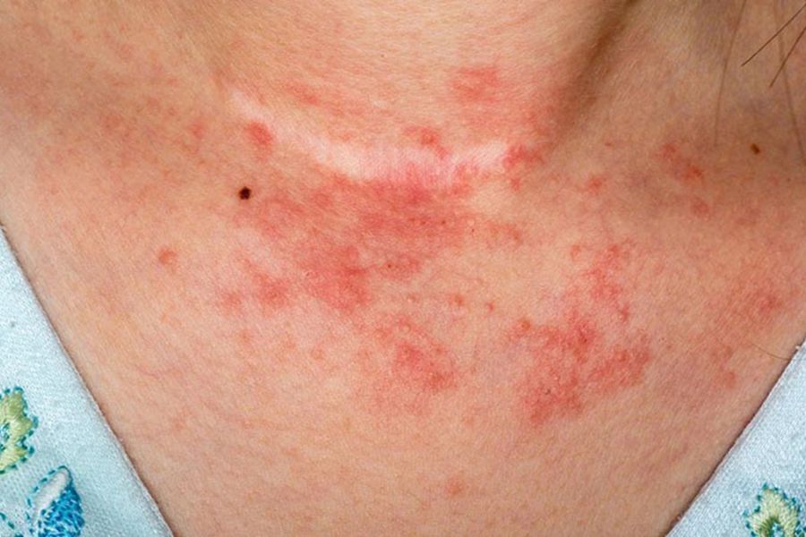 Cách điều trị viêm da cơ địa ở cổ bằng thuốc bôi và dưỡng ẩm đúng cách