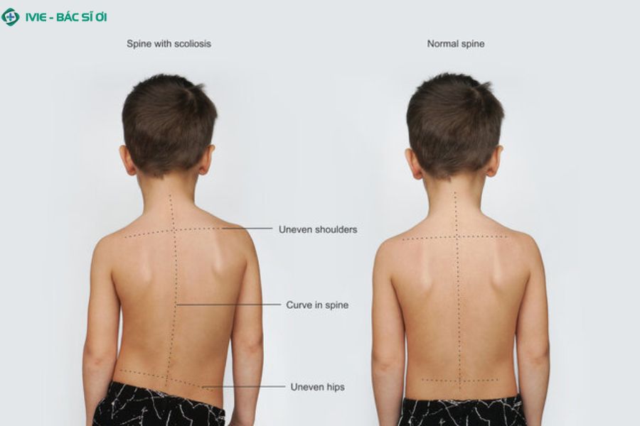 Vai lệch, cột sống không thẳng khi cúi, đau lưng nhẹ là những dấu hiệu sớm cảnh báo cong vẹo cột sống ở học sinh