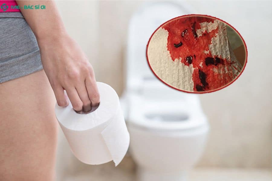 Người bệnh cần đặc biệt chú ý quan sát màu sắc phân để phát hiện sớm dấu hiệu xuất huyết