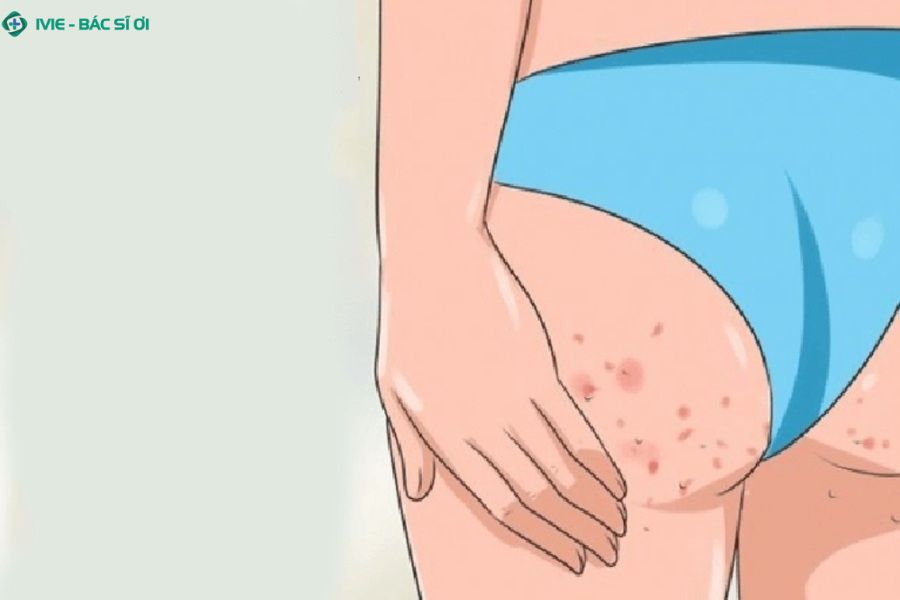 Những tác nhân có thể gây kích ứng, mẩn đỏ ở mông