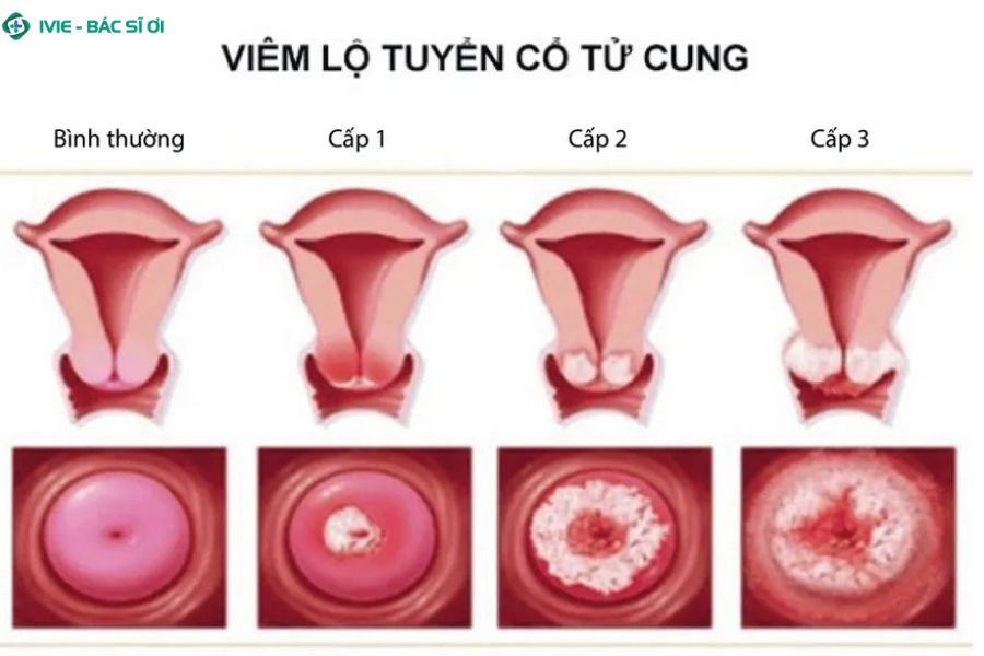 Đặc điểm thay đổi màu sắc khí hư qua các giai đoạn tiến triển của bệnh