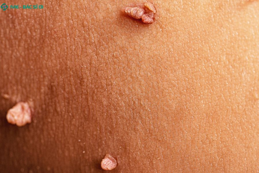 Việc nhận biết sớm các triệu chứng bệnh lậu hay sùi mào gà giúp quá trình điều trị trở nên đơn giản và hiệu quả hơn