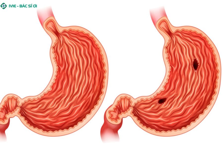 Xuất huyết dạ dày là gì? Nguyên nhân và mức độ nguy hiểm cần biết