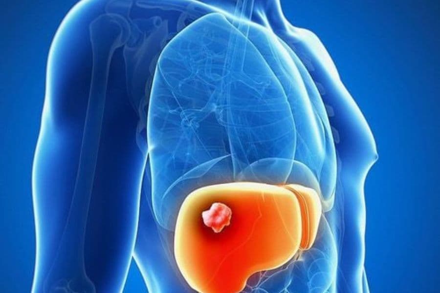 U gan là các khối u bất thường xuất hiện trên gan