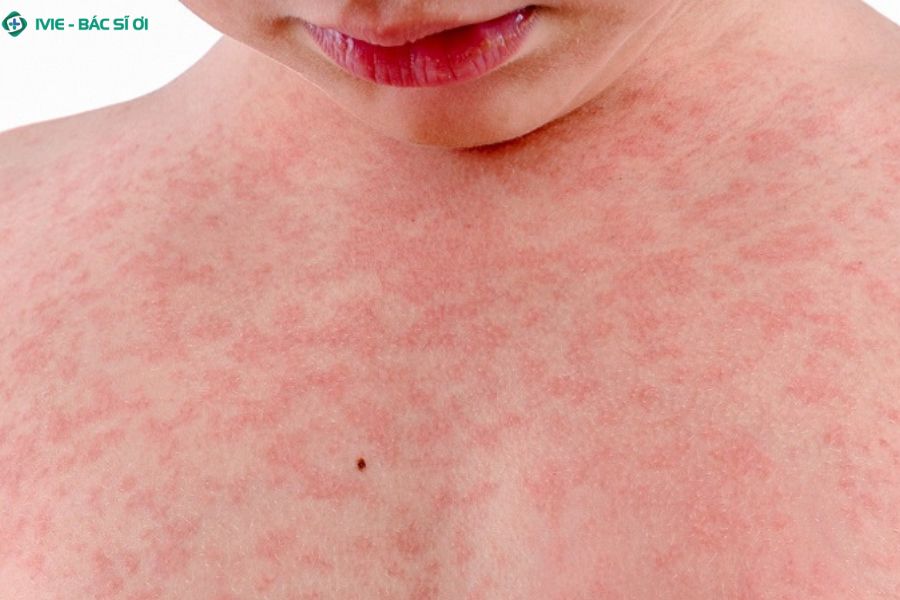 Dị ứng thực phẩm và mỹ phẩm là nguyên nhân phổ biến gây ngứa kèm mẩn đỏ