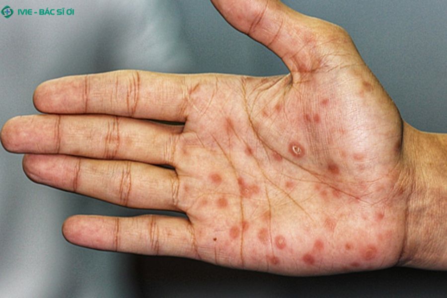 Bệnh giang mai là gì? Có nguy hiểm không?