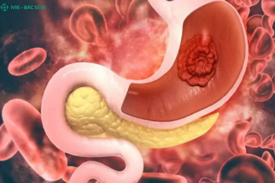 Xuất huyết dạ dày nguy hiểm như thế nào?