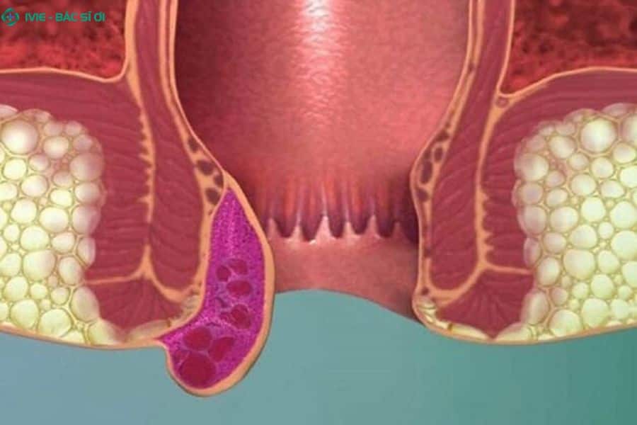 Áp lực từ phân cứng cọ xát vào vách tĩnh mạch bị giãn dẫn đến hiện tượng chảy máu tươi