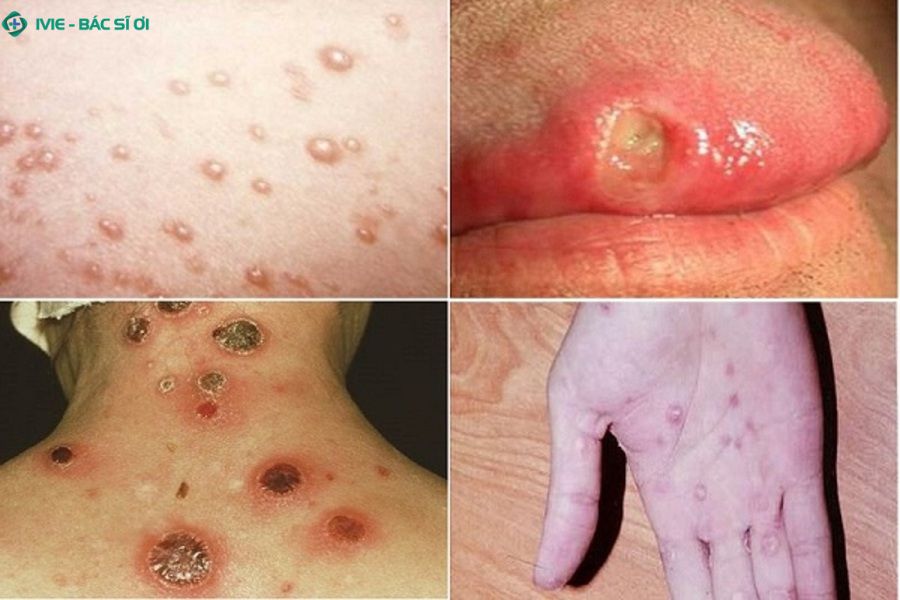 Nguy cơ tiềm ẩn của giang mai nổi mẩn đỏ bạn đặc biệt lưu ý