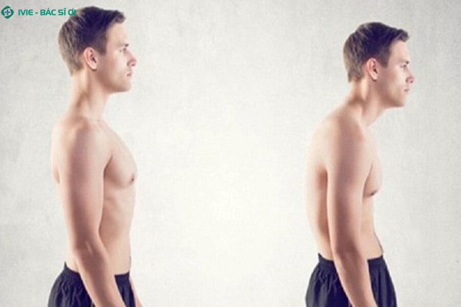 Gù lưng có độ cong trên 40 độ khi đo bằng X-quang