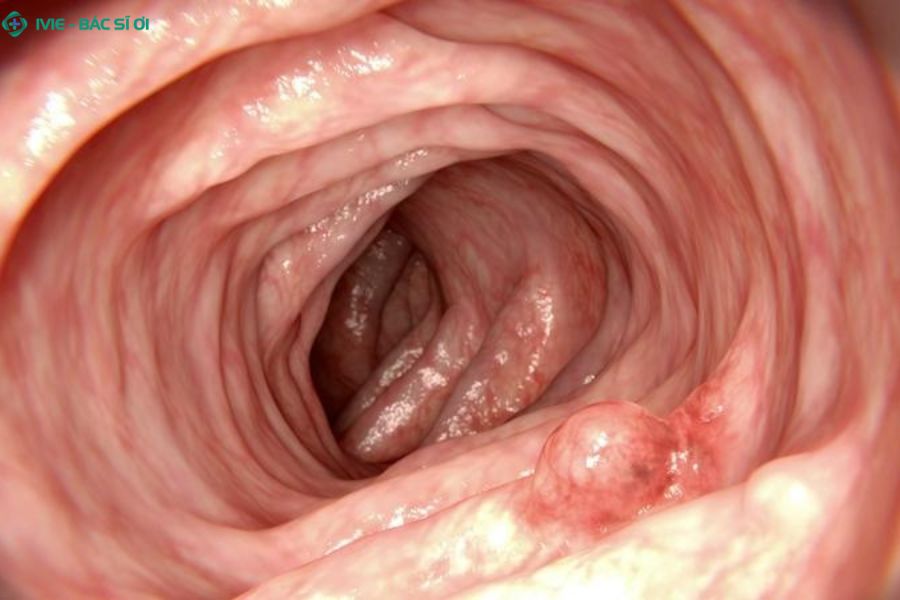 Nội soi đại tràng giúp phát hiện ra các bệnh lý nguy hiểm