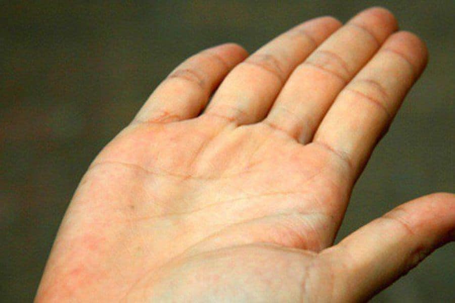 Vàng da là một triệu chứng điển hình của viêm gan A