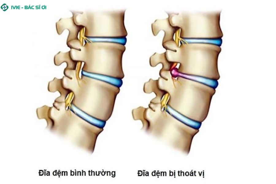 Nhân nhầy tràn ra chèn ép dây thần kinh gây đau lan vai và cánh tay