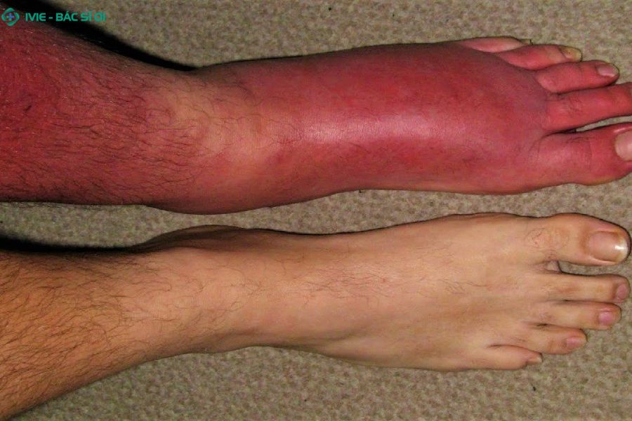 Nhiễm trùng mô mềm quanh ngón chân