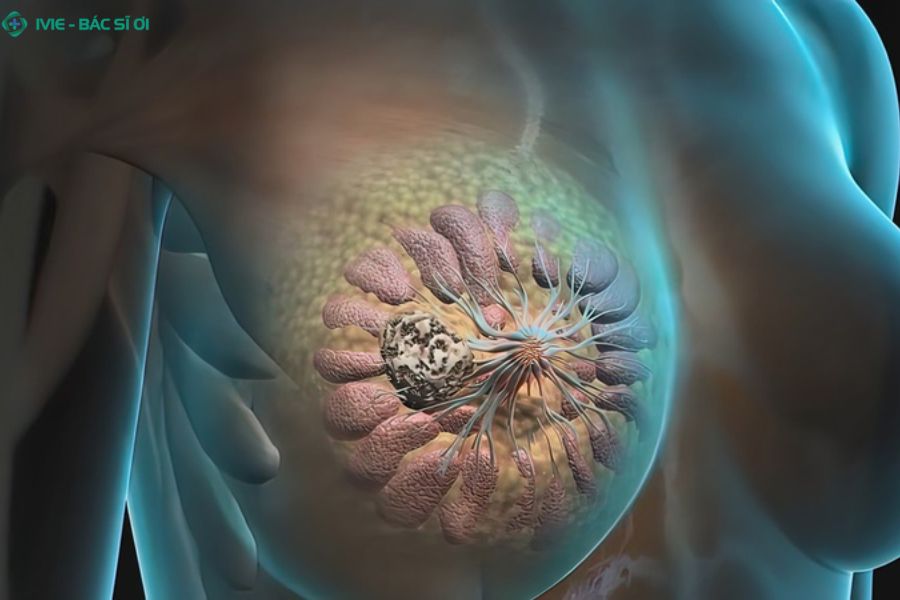 U vú lành tính thường gặp và đặc điểm cơ bản