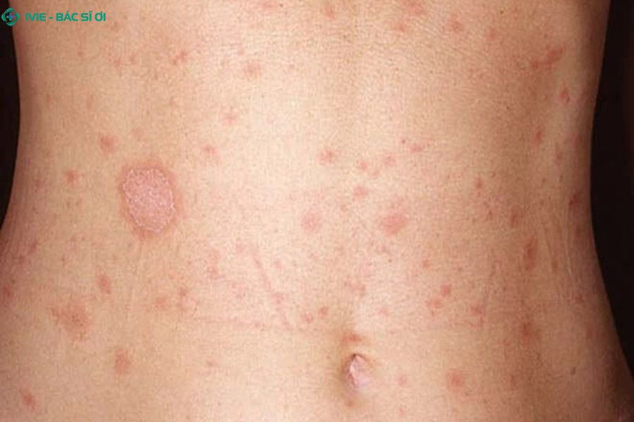 Săng giang mai là gì?