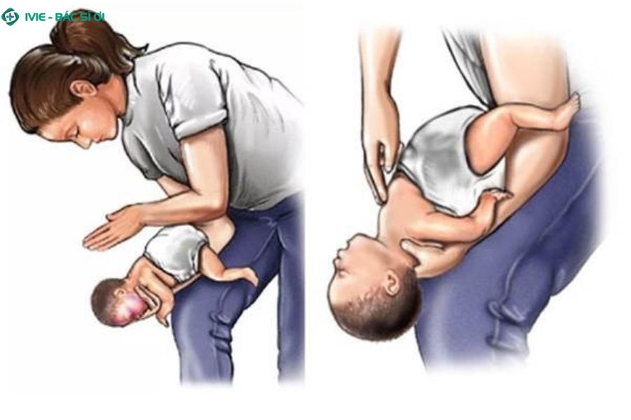 Kỹ thuật vỗ lưng ấn ngực hoặc Heimlich đúng cách có thể cứu sống trẻ khi bị hóc dị vật đường thở