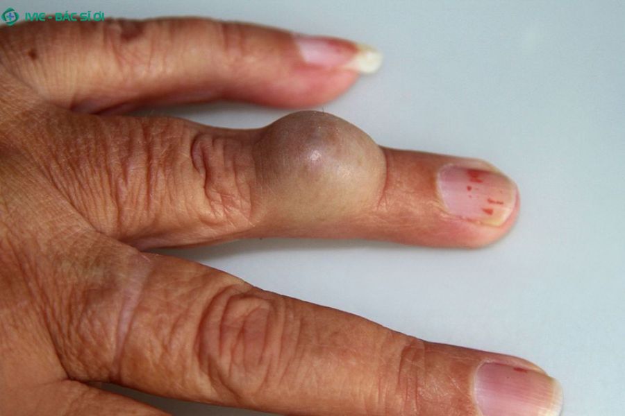 Nguyên nhân gây ra u bã đậu?