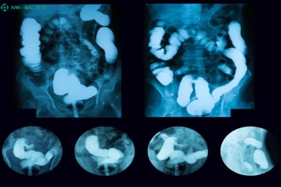 Khi nào cần chụp X-quang tiêu hóa