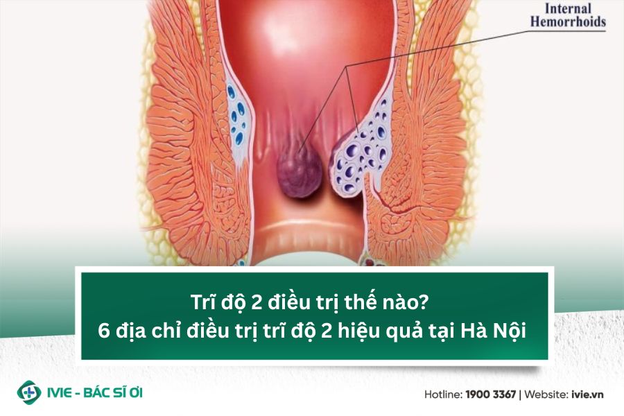 Trĩ độ 2 điều trị thế nào? 6 địa chỉ điều trị trĩ độ 2 hiệu ...