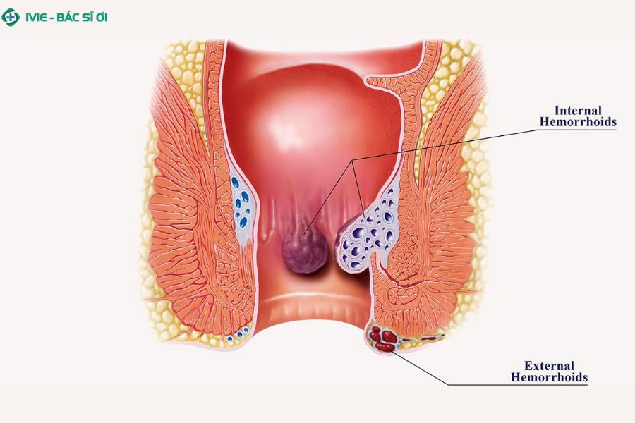 Trĩ độ 4 là gì và dấu hiệu nhận biết
