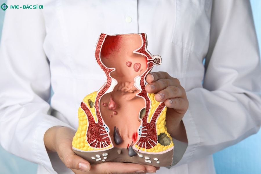 Búi trĩ có tự rụng tại nhà không?