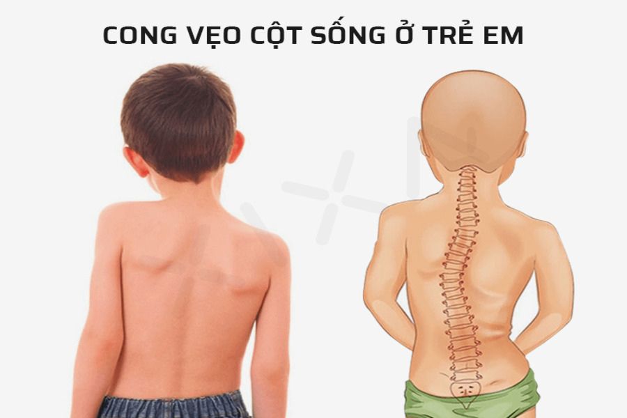 Tật cong vẹo cột sống có thể được phát hiện sớm nếu người bệnh hoặc người thân chú ý đến các dấu hiệu đặc trưng