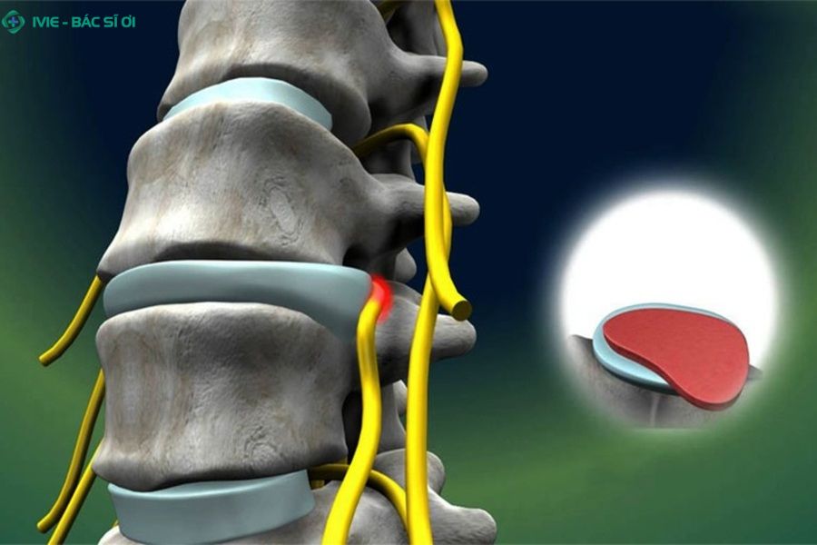 Mổ thoát vị đĩa đệm cần bao lâu để hồi phục
