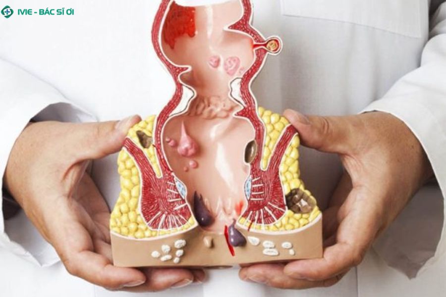 Tìm hiểu về trĩ độ 2