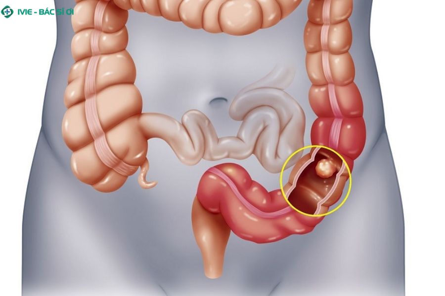 Nguyên nhân đau bụng bên trái ngang rốn do đại tràng