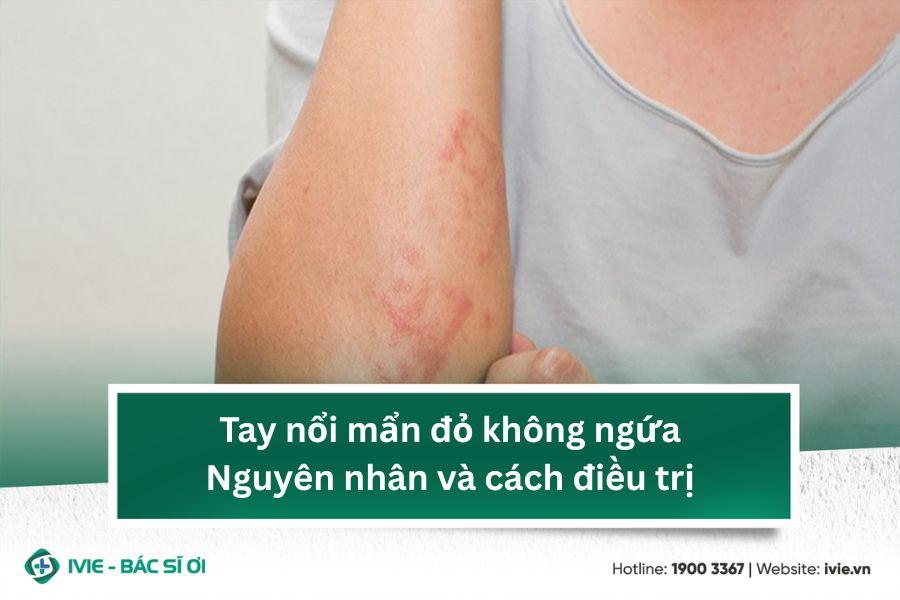 Tay nổi mẩn đỏ không ngứa: Nguyên nhân và cách điều trị