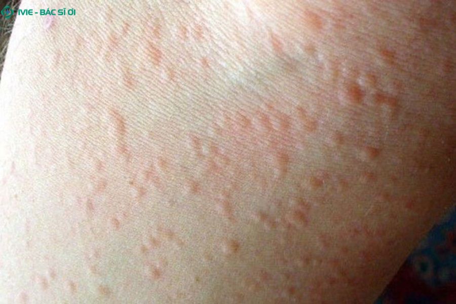 Phản ứng quá mức của hệ miễn dịch trước yếu tố môi trường gây nổi mẩn đỏ