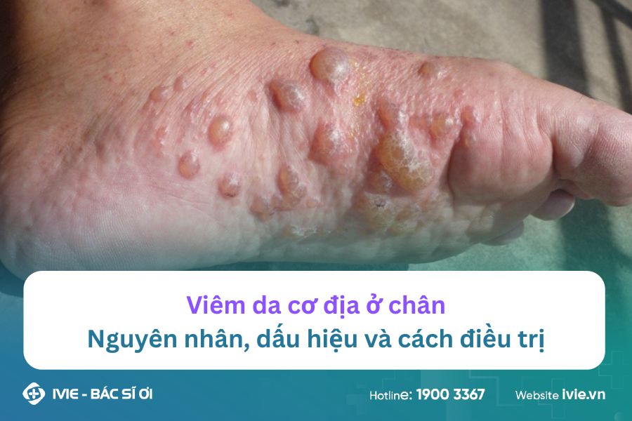 Viêm da cơ địa ở chân: Nguyên nhân, dấu hiệu và cách điều...
