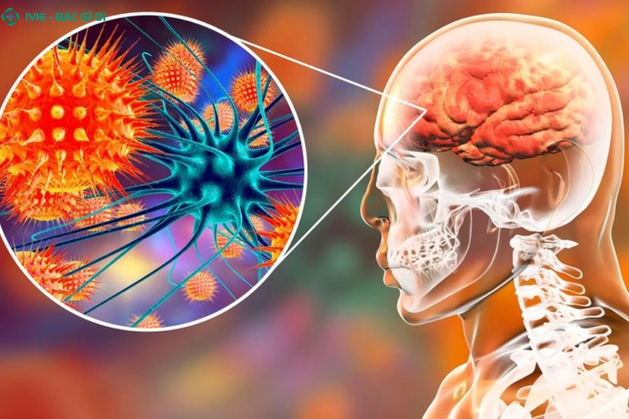 Triệu chứng nhiễm virus Nipah