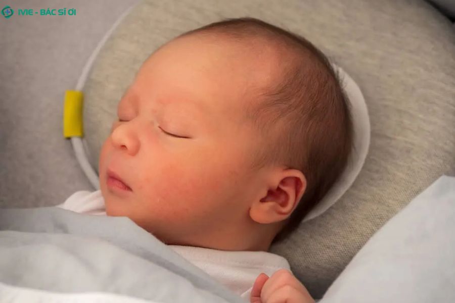 Méo đầu ở trẻ 3 tháng tuổi có nguy hiểm không