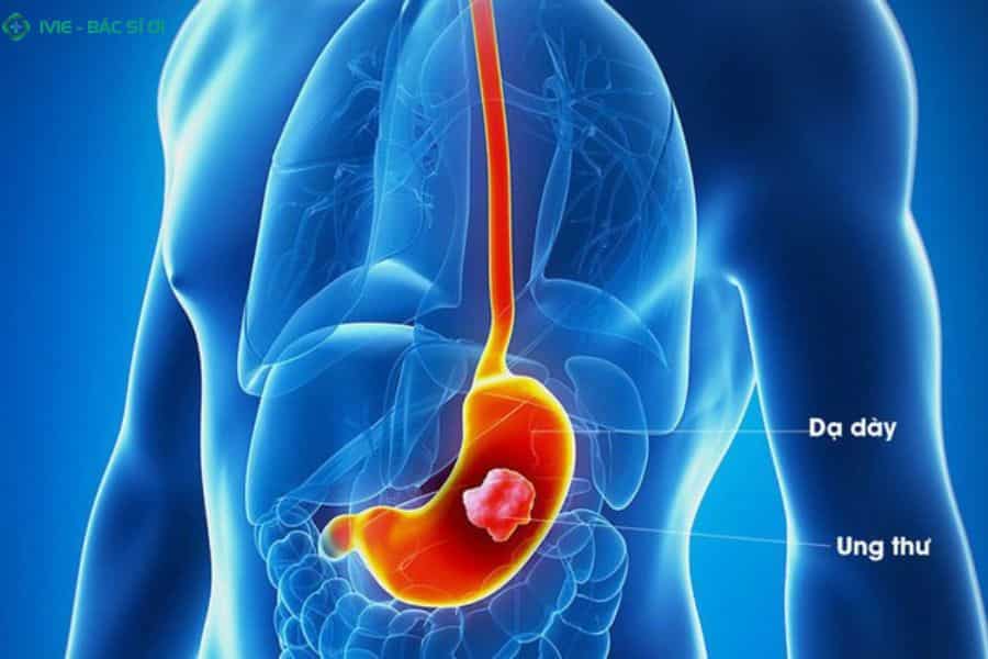 Ung thư dạ dày là bệnh lý ác tính cần được nội soi để phát hiện ở giai đoạn sớm
