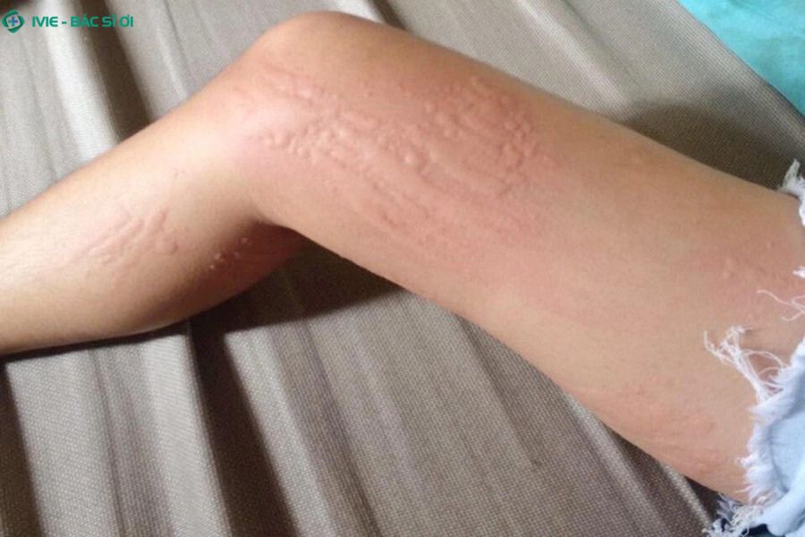 Dị ứng lạnh chỉ gây ra các mẩn đỏ, ngứa rát, sưng nhẹ hoặc cảm giác châm chích