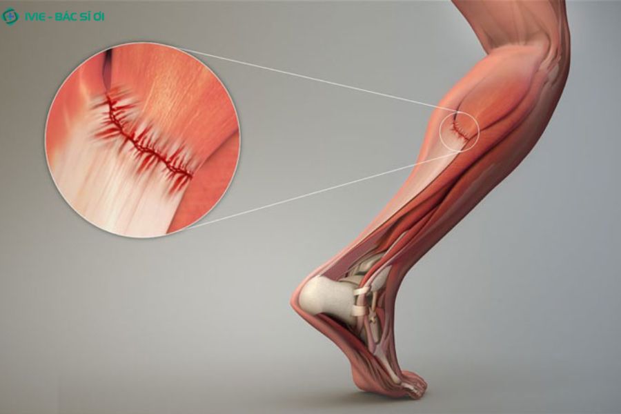 Các sợi cơ bị kéo giãn gây đau và cứng vùng sau cẳng chân