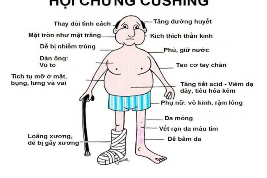 Những điều cần biết về hội chứng Cushing