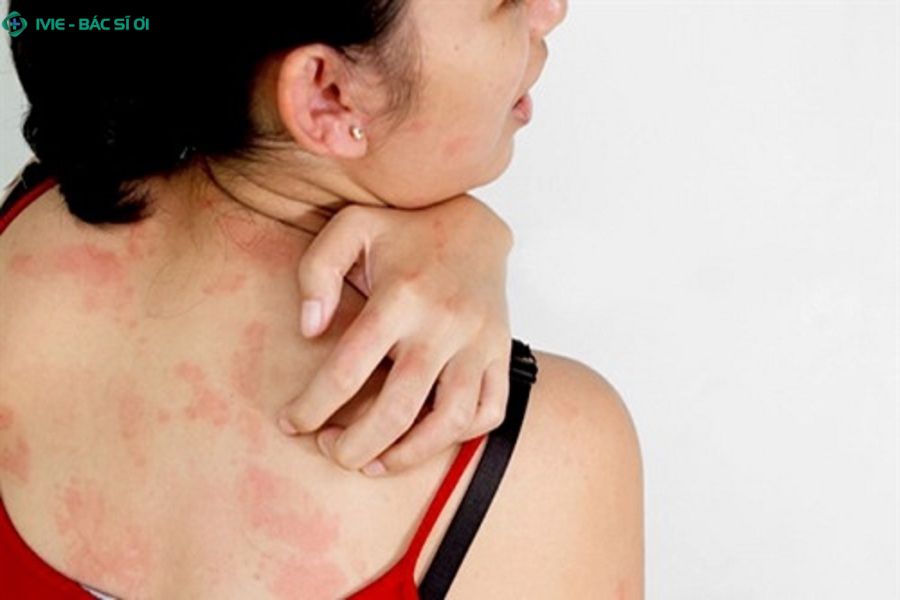 Những triệu chứng nguy cơ nhiễm ký sinh trùng bạn cần lưu ý