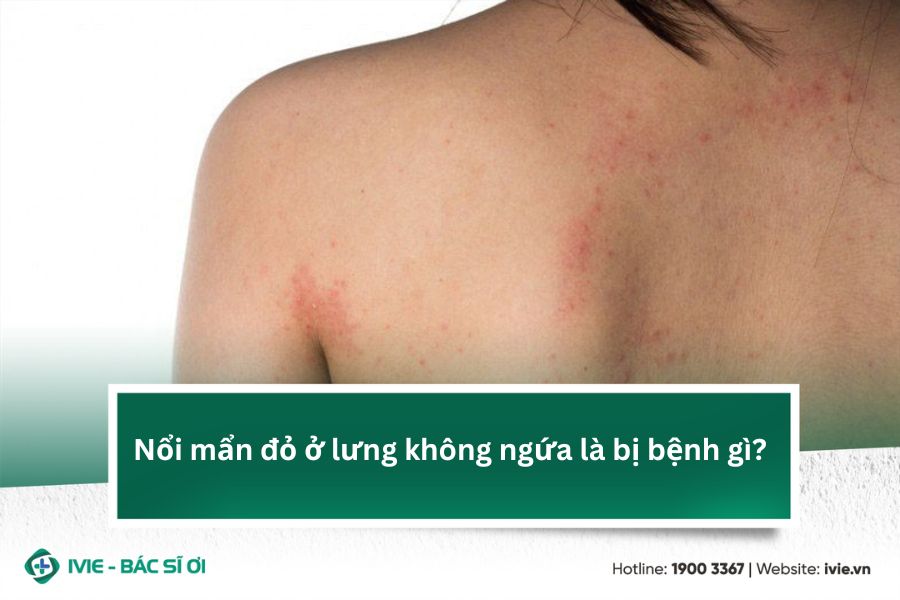 Nổi mẩn đỏ ở lưng không ngứa là bị bệnh gì?
