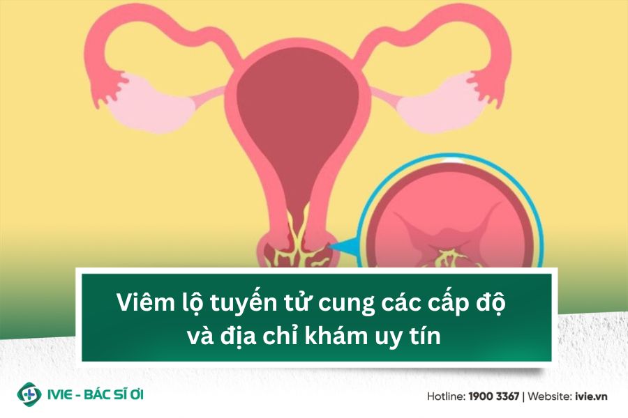 Viêm lộ tuyến tử cung các cấp độ và địa chỉ khám uy tín
