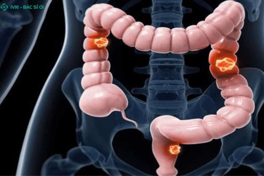 Ung thư đại trực tràng tiến triển âm thầm với triệu chứng đi ngoài ra máu đỏ sẫm