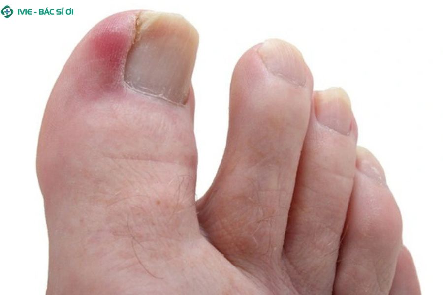 Cách xử lý sưng đau nhẹ ở ngón chân tại nhà